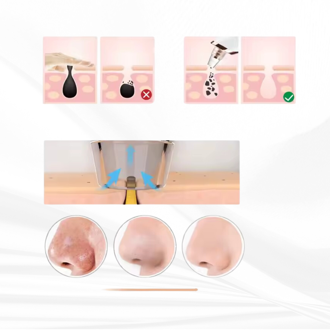 Vacuum Cleansing Device - Afbeelding 3